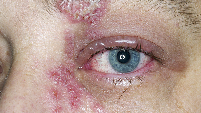 Close up of a shingles rash around a blue eye