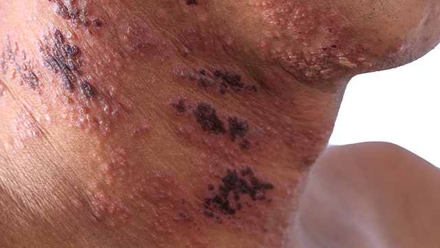 Close up of a shingles rash on a neck