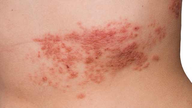 Close up of a shingles rash on a torso Close up of a shingles rash on a torso